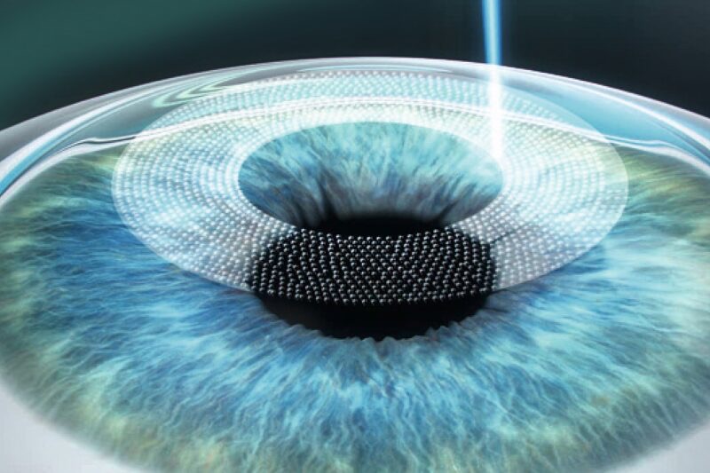 Femtolasik - Cirugía refractiva con láser de femtosegundo en Bogotá