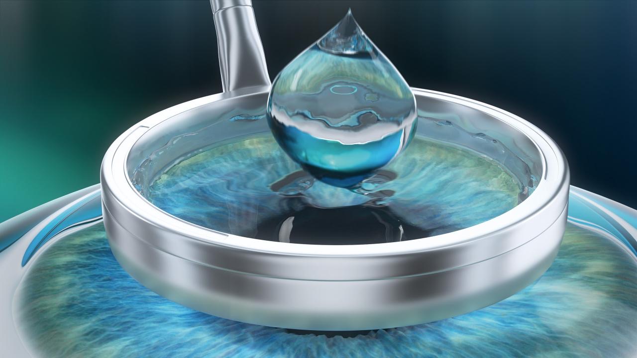 PRK - Queratectomía fotorrefractiva en Bogotá