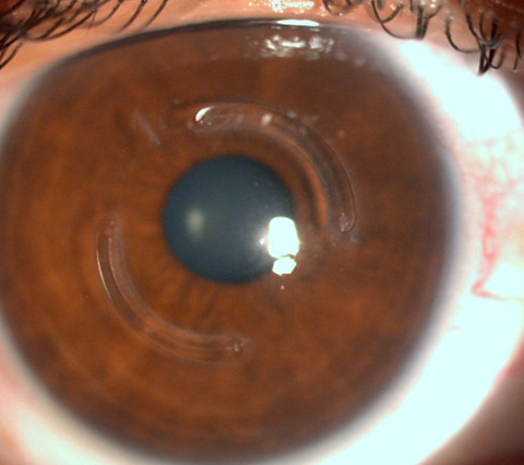 Anillo intracorneal on sale