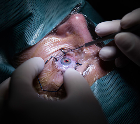 Tenemos modernos equipos para una cirugía láser de ojos en Bogotá Cirugía láser de ojos en Bogotá, hombre sometido a operación